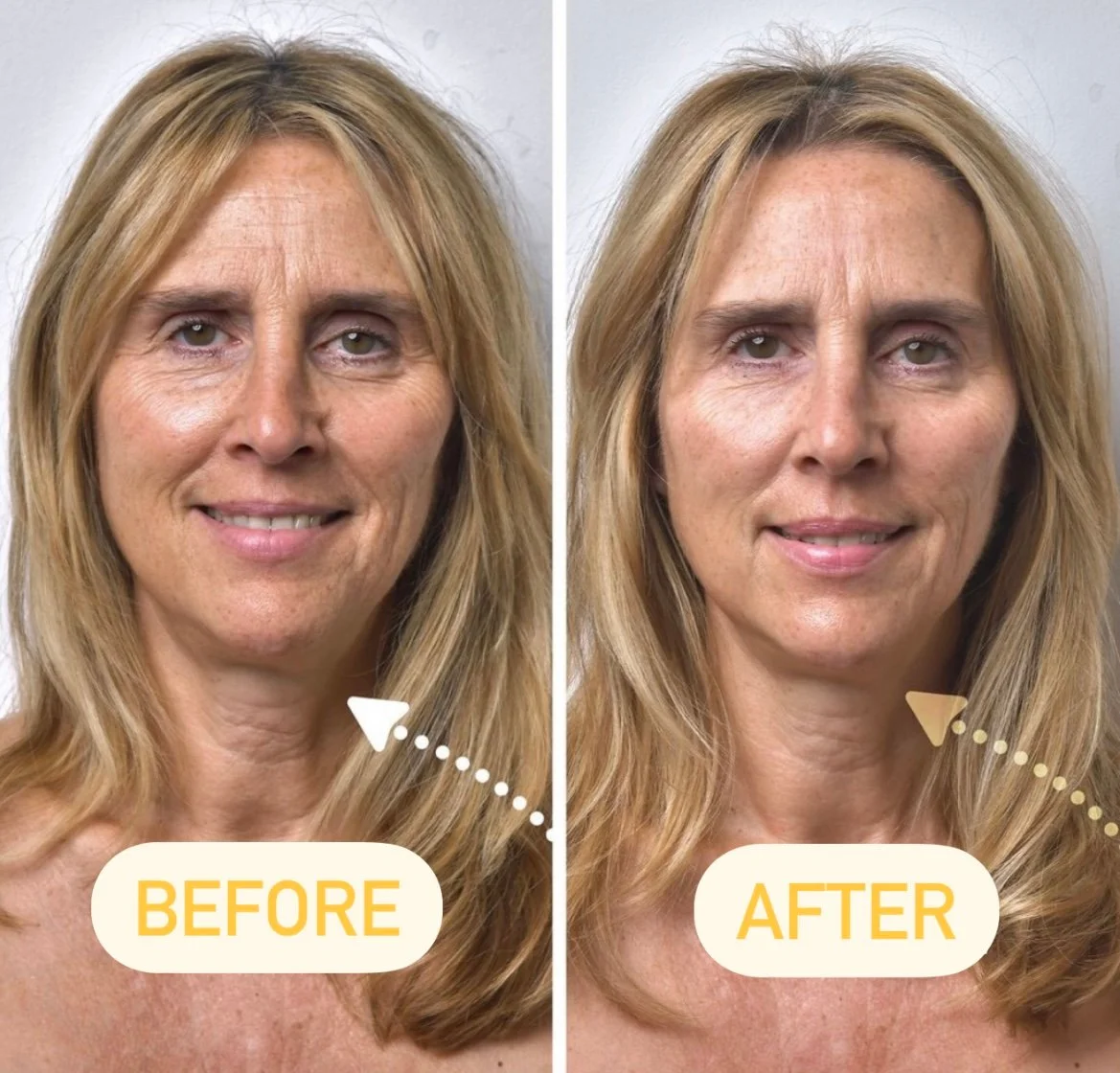 Before-after